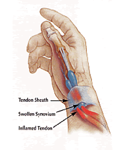 De quervain’s Tenosynovitis - Capital Physiotherapy