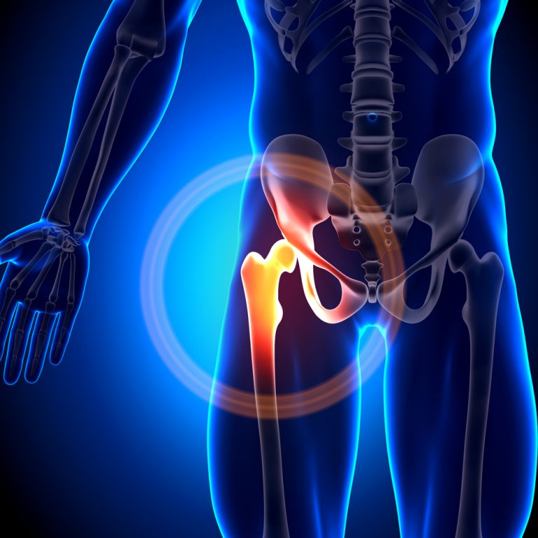Snapping Hip Syndrome Capital Physiotherapy