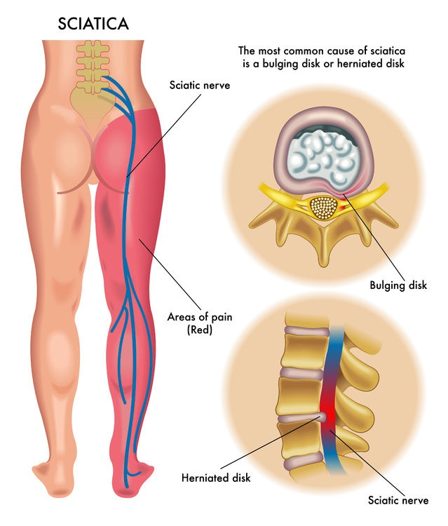 capital-physiotherapy-sciatia-anatomy-diagram