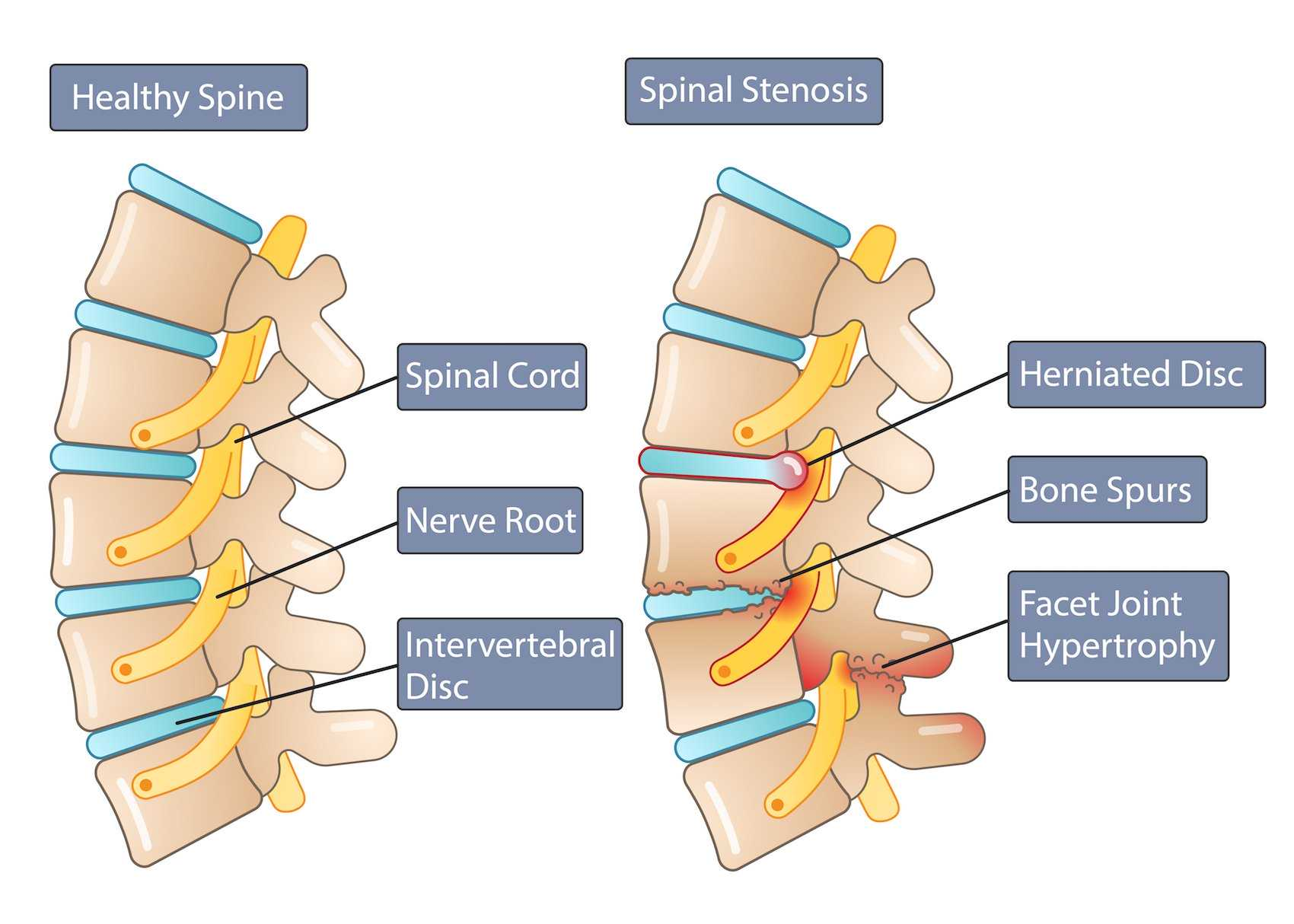 Sciatica Fix Without Surgery Spinal Stenosis Capital Physiotherapy