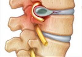 capital-physiotherapy-herniated-disc-diagram