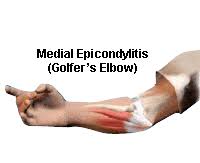 medial-epicondylitis-golfers-elbow-diagram