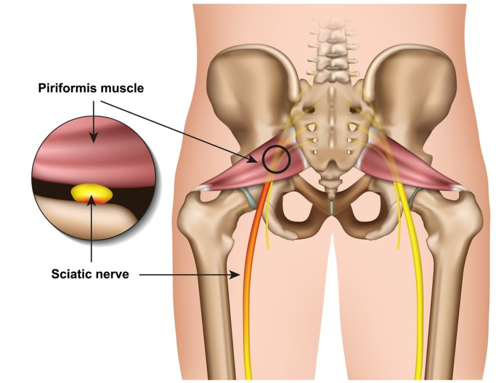 capital physiotherapy piriformis muscle sciatic nerve diagram